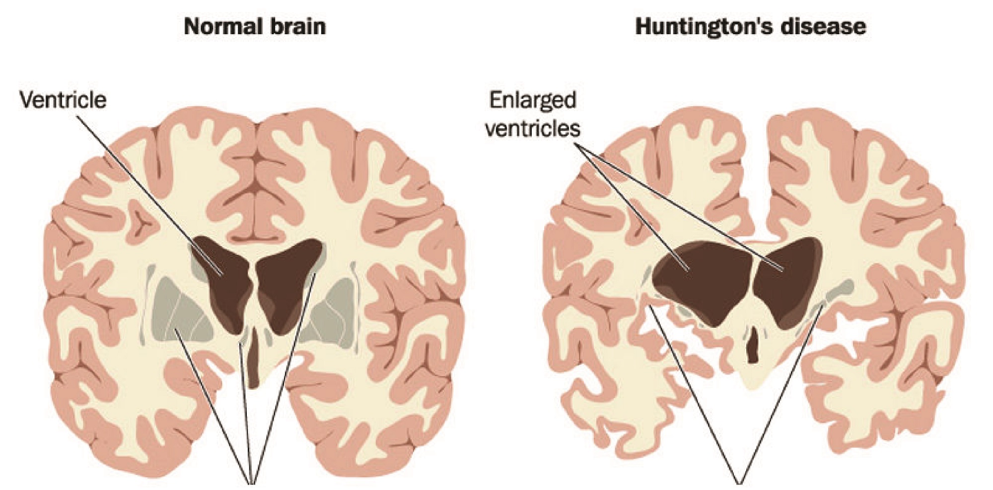 What are the Signs and Symptoms of Huntington’s Disease